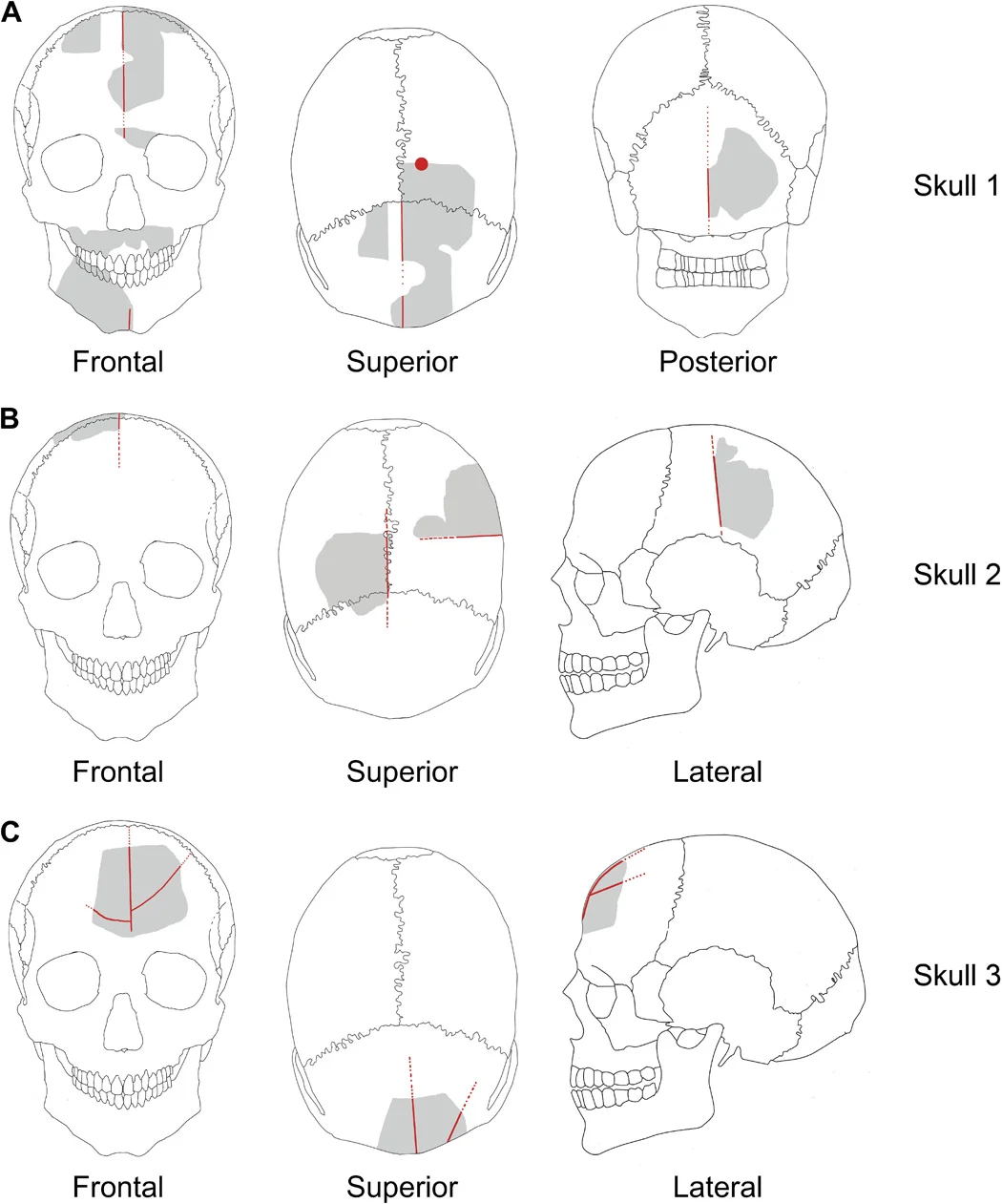 Gobekli Tepe Skull Artificial Modifications